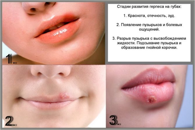 Stages of development of herpes on the lips