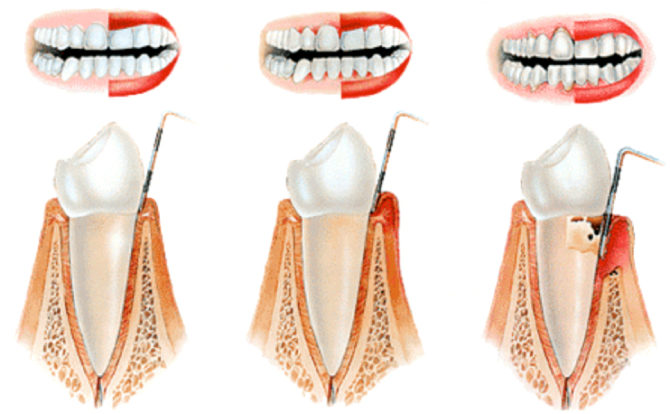 Stadier av tandköttsinflammation