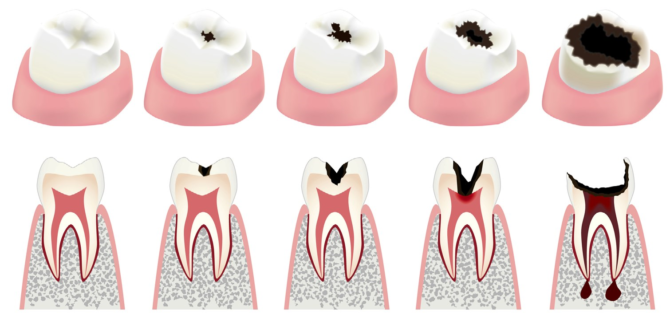 Fáze zubního kazu