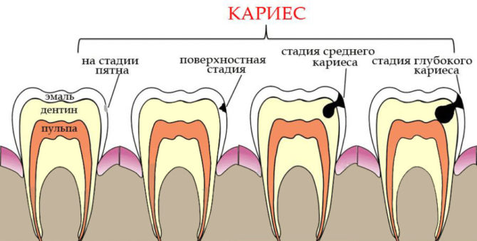Các giai đoạn của sâu răng