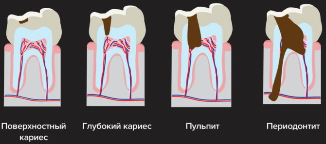 Fázy zubného kazu