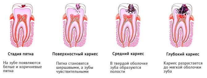 Fázy zubného kazu