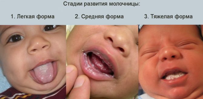 Các giai đoạn phát triển của bệnh tưa miệng