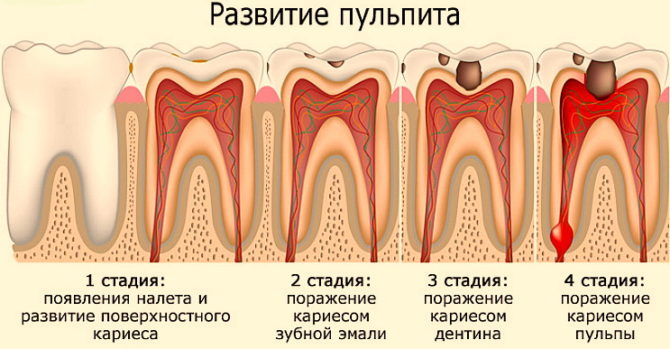 مراحل تطور التهاب اللب