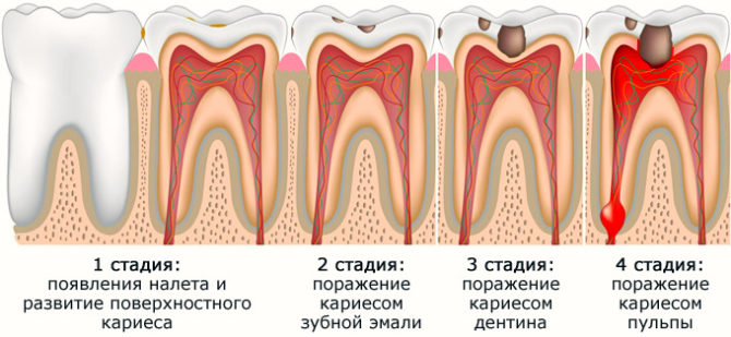 Etapy rozwoju chorób zębów