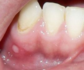 التهاب الفم على اللثة