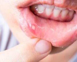 Estomatitis en los labios