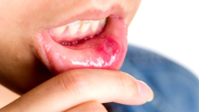 Stomatitis an der Innenseite der Lippe