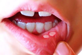 Stomatitis on the inside of the lip
