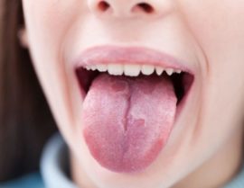 Estomatite na língua