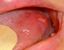 Stomatitis in der Zunge