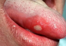 Stomatitis on the tongue (glossitis)