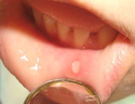 Stomatitis דרך הפה