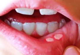 Stomatitis דרך הפה