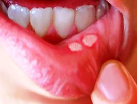 Oral stomatit