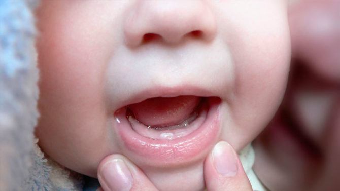 Viêm miệng ở trẻ sơ sinh