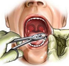 Tandläkaren drar ut en tand