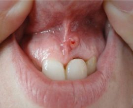 Fistula on the gums of the baby