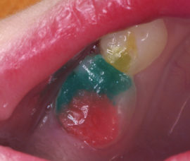 Colored fillings for baby teeth