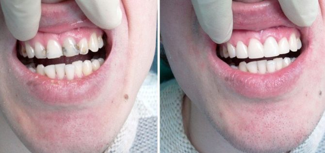 Placage thérapeutique sur la dent avant