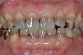 Dentes de tetraciclina