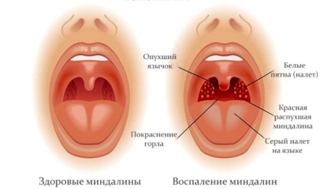 mandulagyulladás