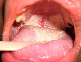 Tonsillomycosis