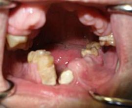 Osteomielitis traumática de la mandíbula inferior