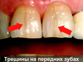 Des fissures dans les dents de devant