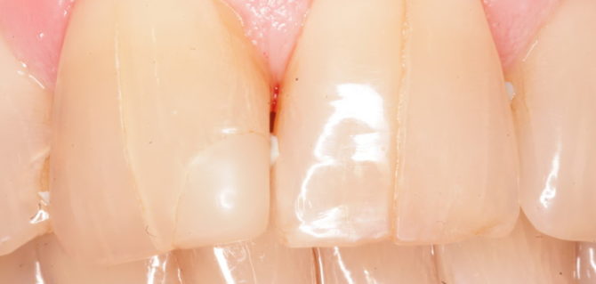 Dents fissurées