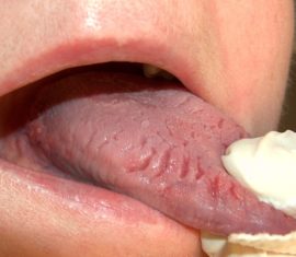 Sprickor på tungans sidor