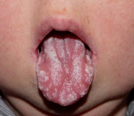 Curd di mulut bayi