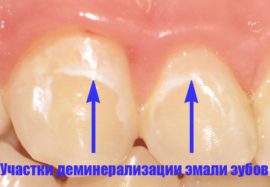 Dental enamel demineralization sites