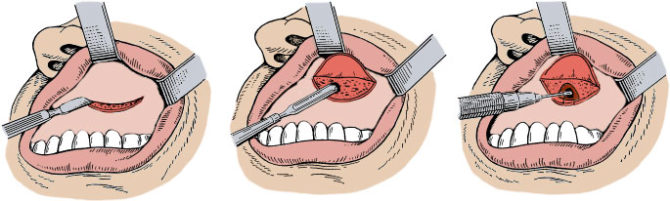 Removal of a cyst according to the method of Caldwell-Luc