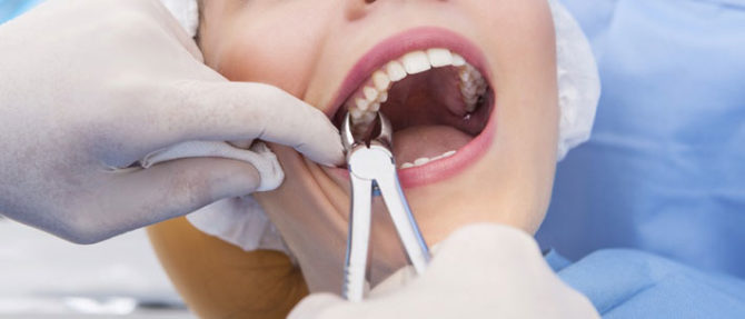 Removing the root of a decayed decayed tooth