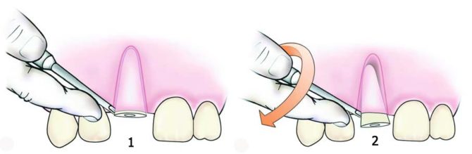 Extrakcia zubov výťahom