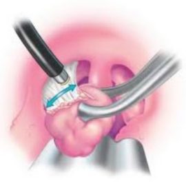 Pag-alis ng mga plug ng tonsilitis