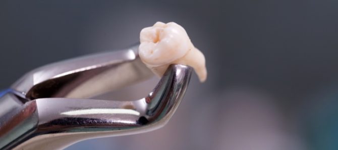 Removal of a tooth