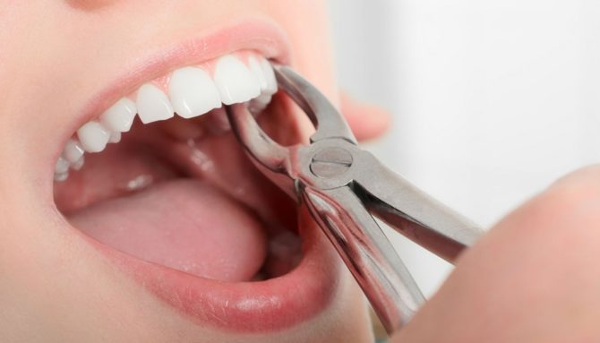 Extrakce zubu