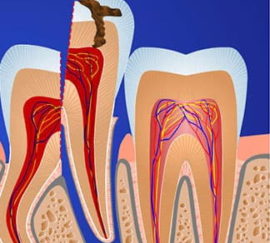 Extrakce zubů po částech
