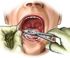Extracción dental por cirujano