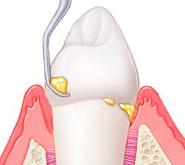 Odstranění zubního kamene