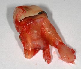 Pašalintas dantis su cistine kapsule