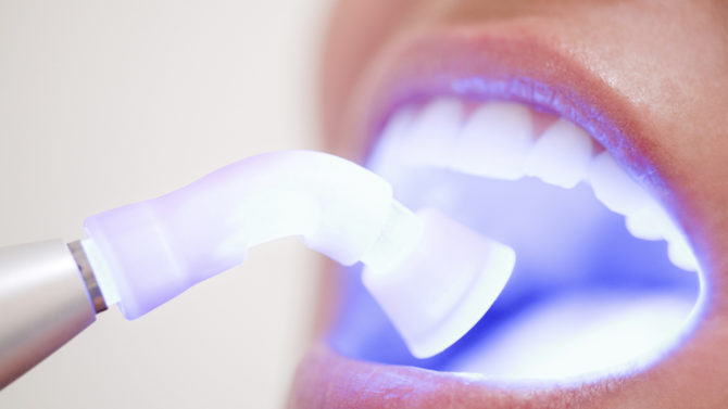 Ultrazvukové čištění zubů z kamene