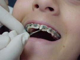 Installing dental braces