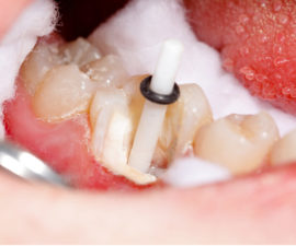 Smeigtukas pritvirtintas prie danties šaknies