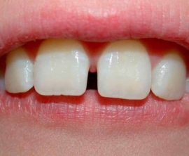 Zvětšené mezery mezi zuby dítěte