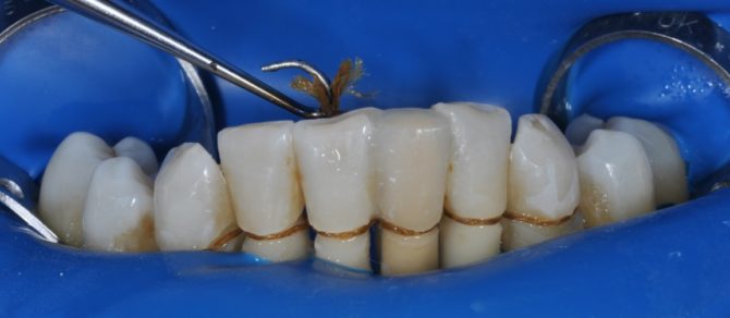 Entablillado de dientes atirantados