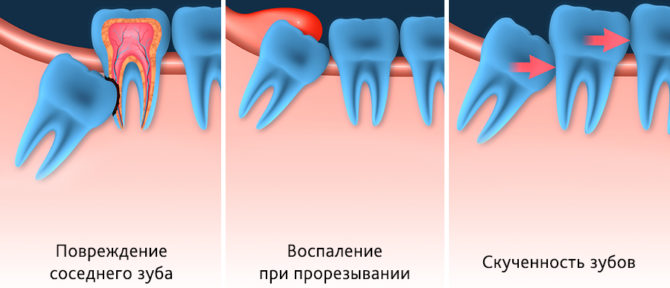 Opciones de crecimiento de dientes incorrectas