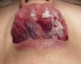 Verruköse Leukoplakie der Mundhöhle